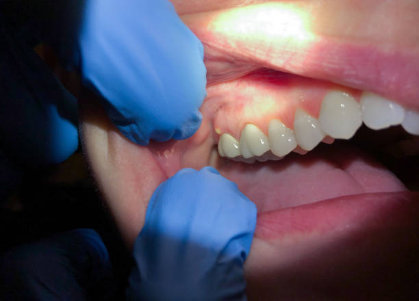 Best Emergency Denture Repair in Quinlan, TX