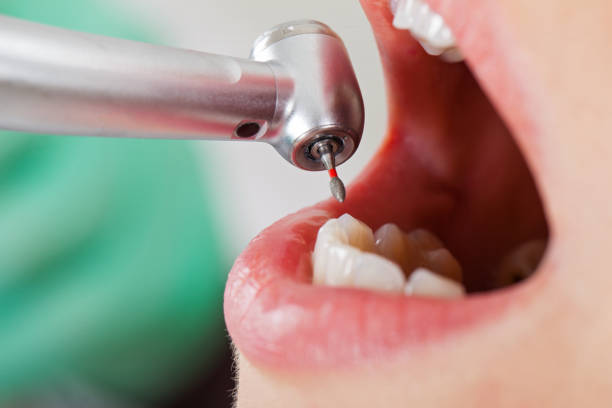 Best Emergency Dental Care for Broken or Chipped Teeth in Quinlan, TX
